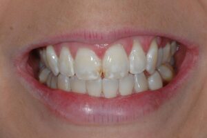 white spots on teeth 2