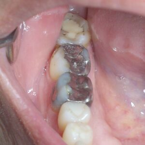fillings causing weakness in teeth
