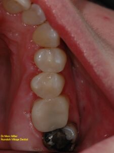 the larger molar will be best treated with a crown in the near future.