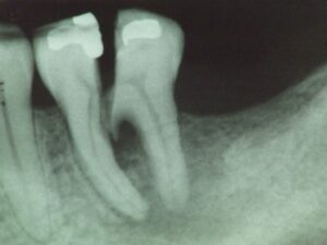 split tooth on x-ray