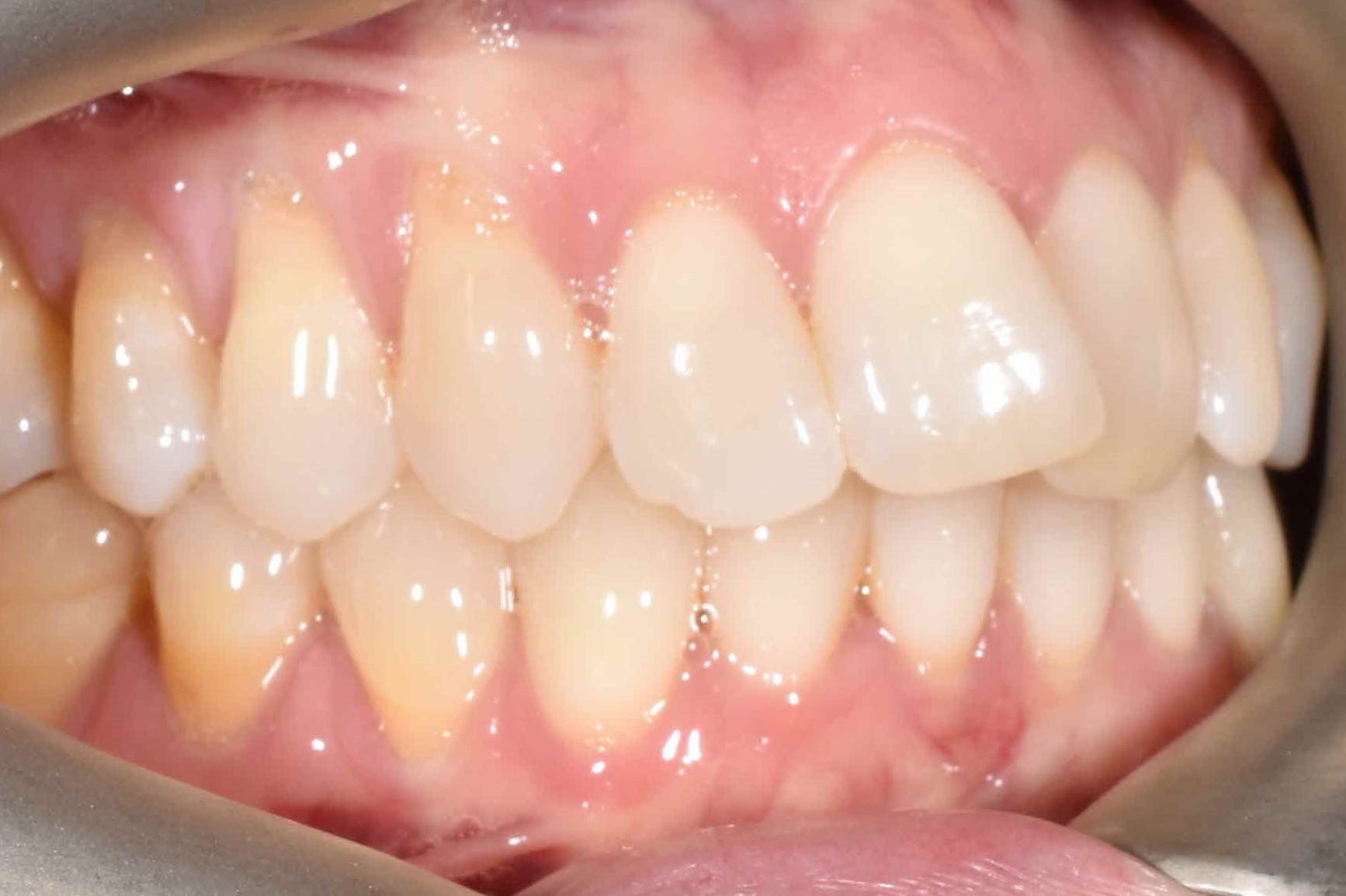 Clear Aligner Before