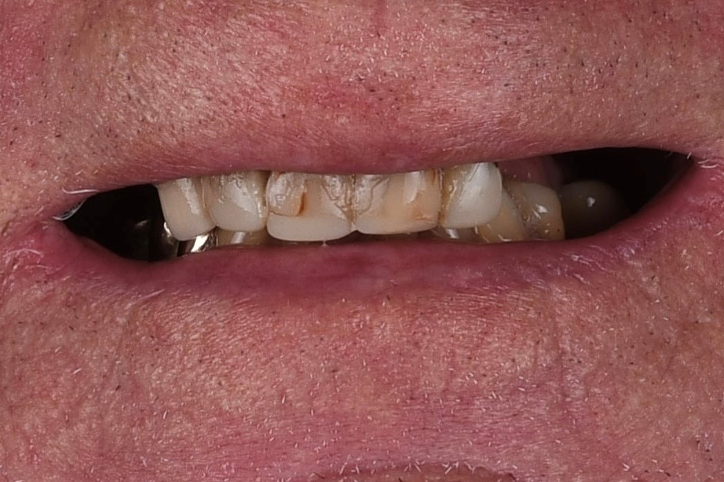 Implantt Upper Teeth before