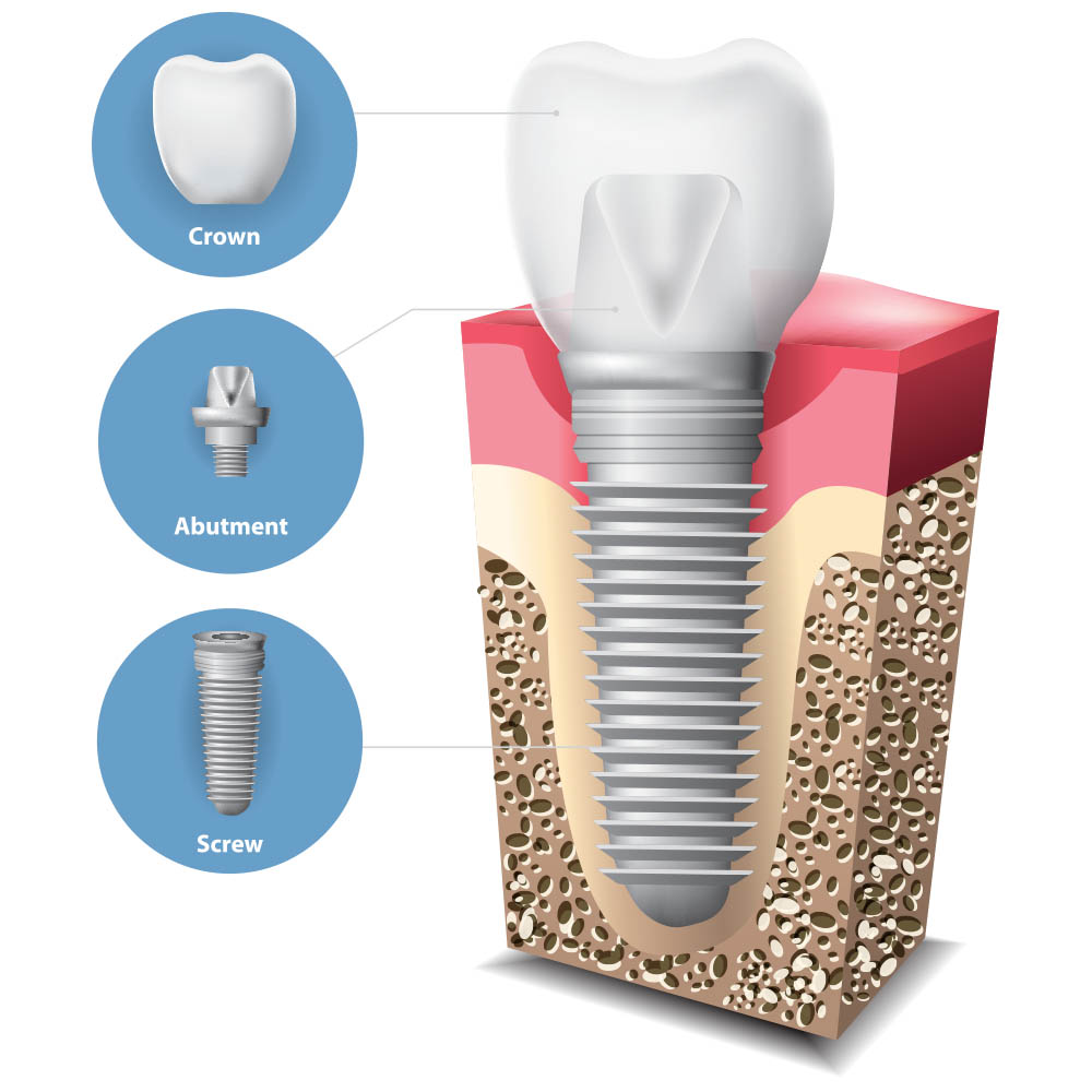 Implants Cosmetic Dentist Brisbane Northside | Nundah Village Dental